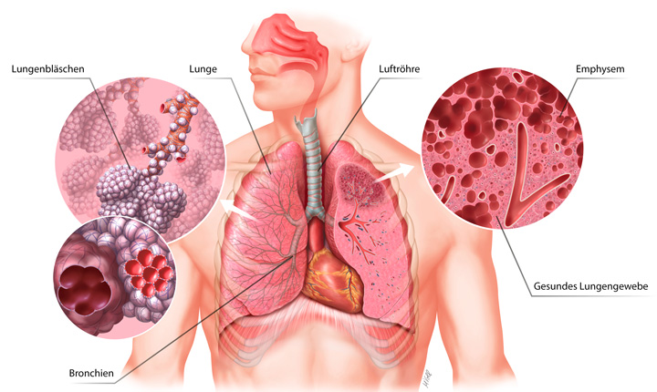 Die Lunge: Über die Lungenbläschen gelangt die Luft in das Blut. 